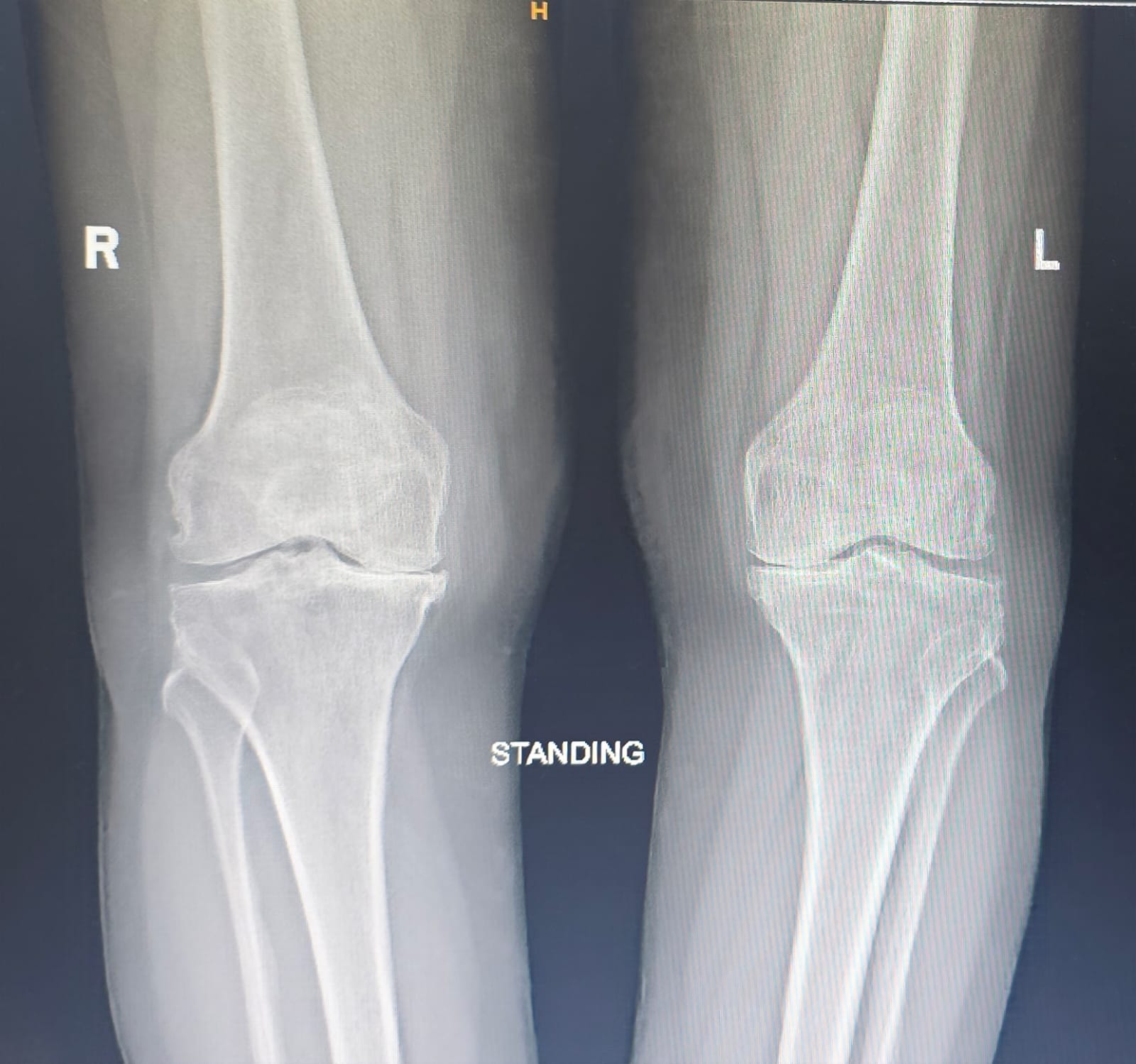 Before hip fracture fixation X-ray